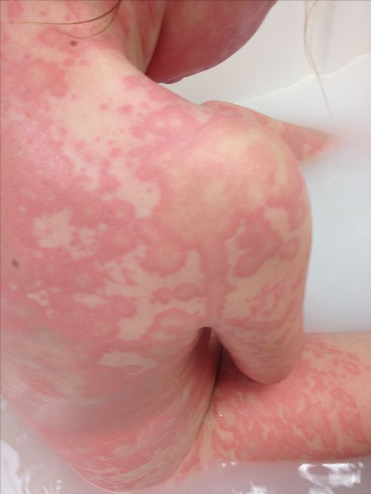 Severe urticaria (hives) in 6 year old child